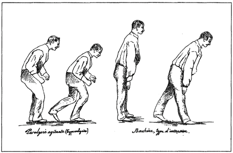 Parkinsoni tõvega patsient - Jean-Marie Charcot joonistus 1888. aastal. 
