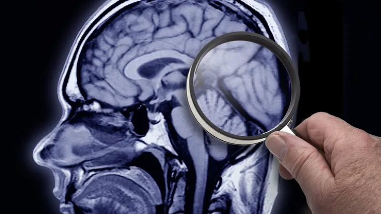 Изучение МРТ-снимка мозга через лупу.