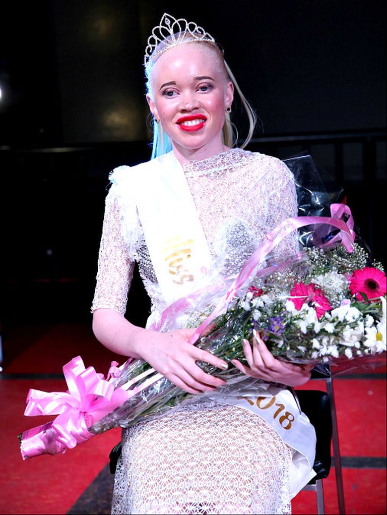 Победительница конкурса «Мисс Альбинос» Ситхембисо Мутукуре. 