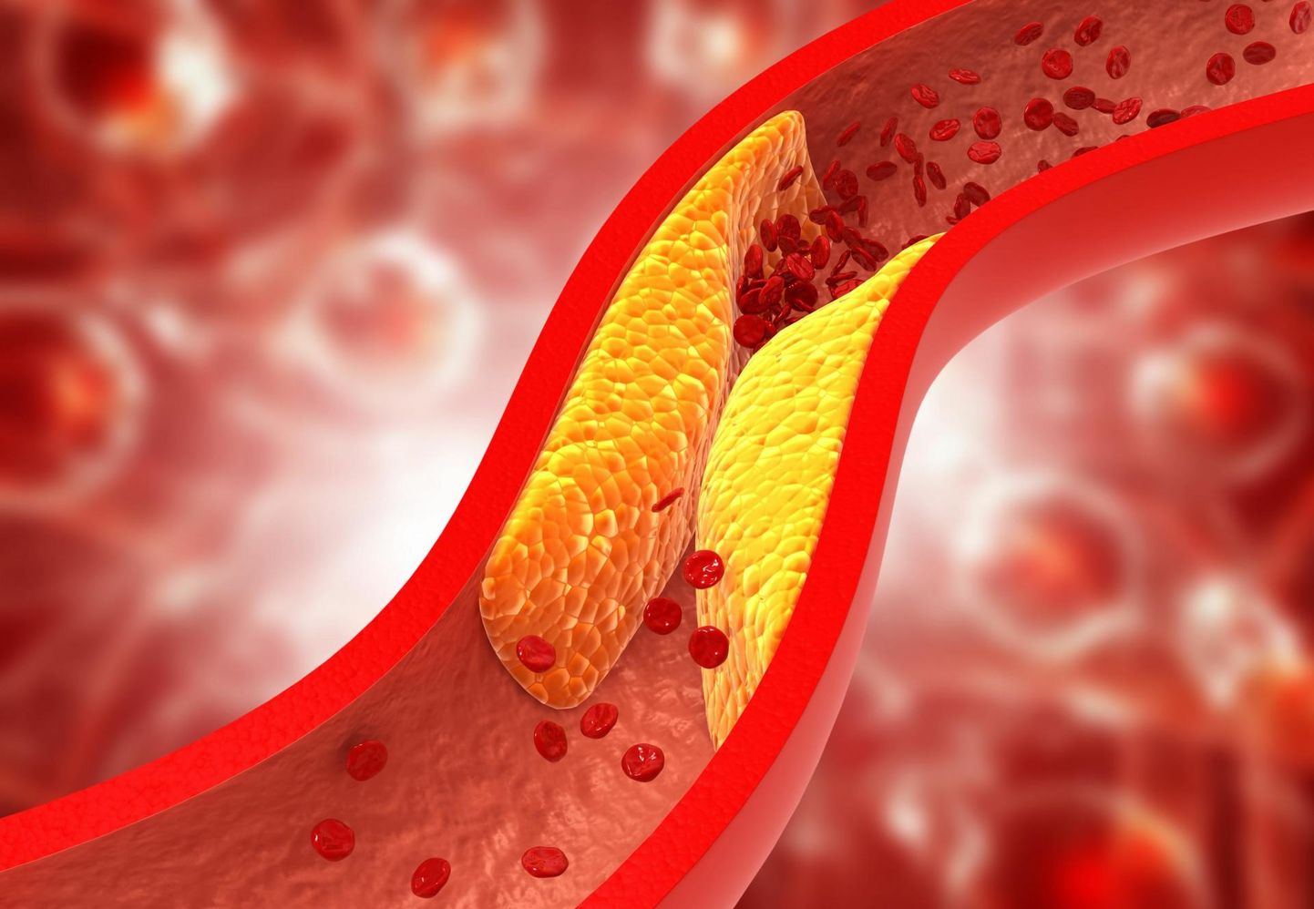 Kõrge LDL- ehk «halb» kolesterool on üks peamisi südamelihase infarkti ja insuldi riskitegureid. 