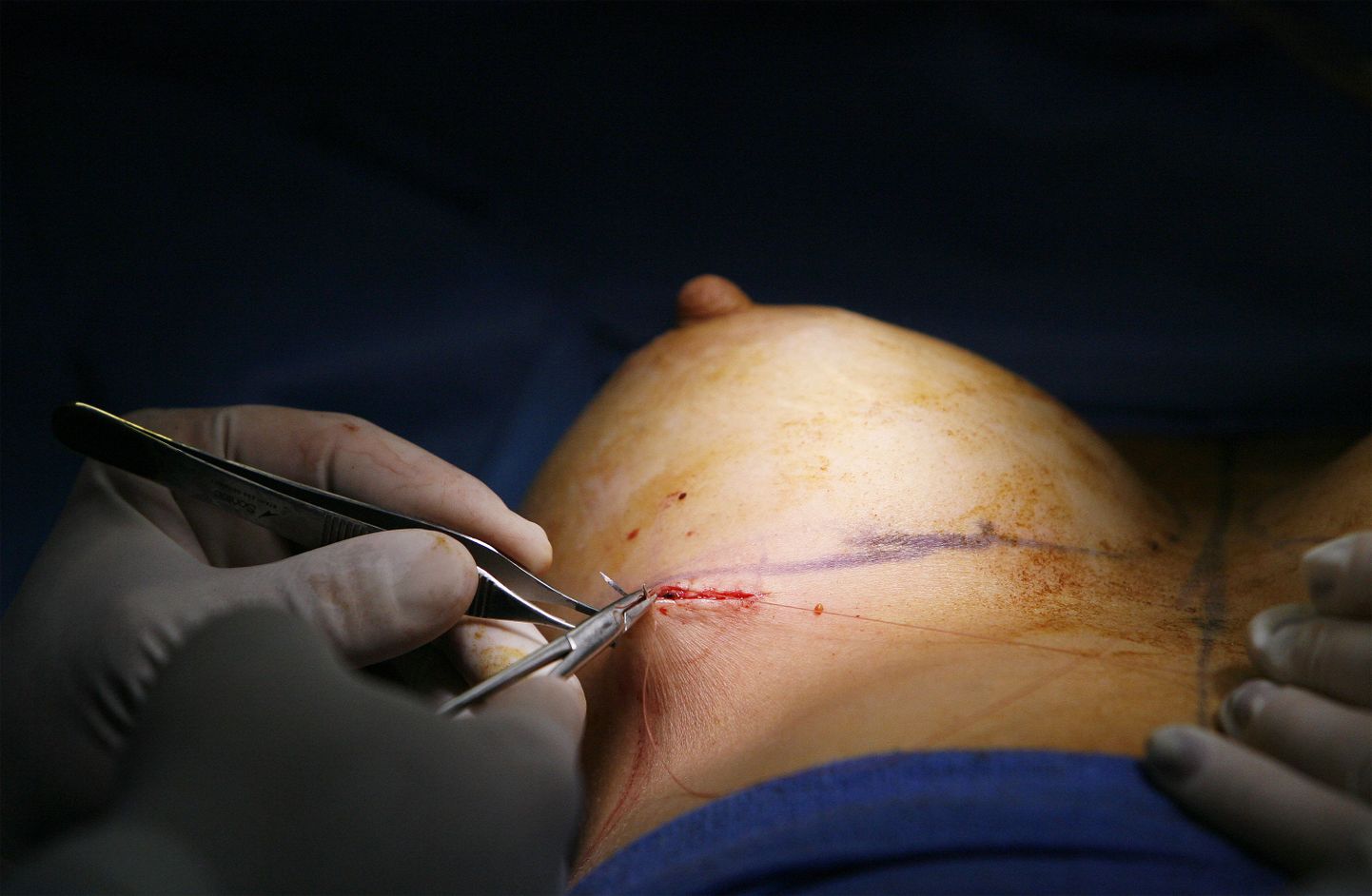 Iisraeli ilukirurg leiutas nahaaluse «rinnahoidja»