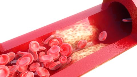 Läbilõige ateroskleroosiga arterist. Läbilõige ateroskleroosiga arterist.