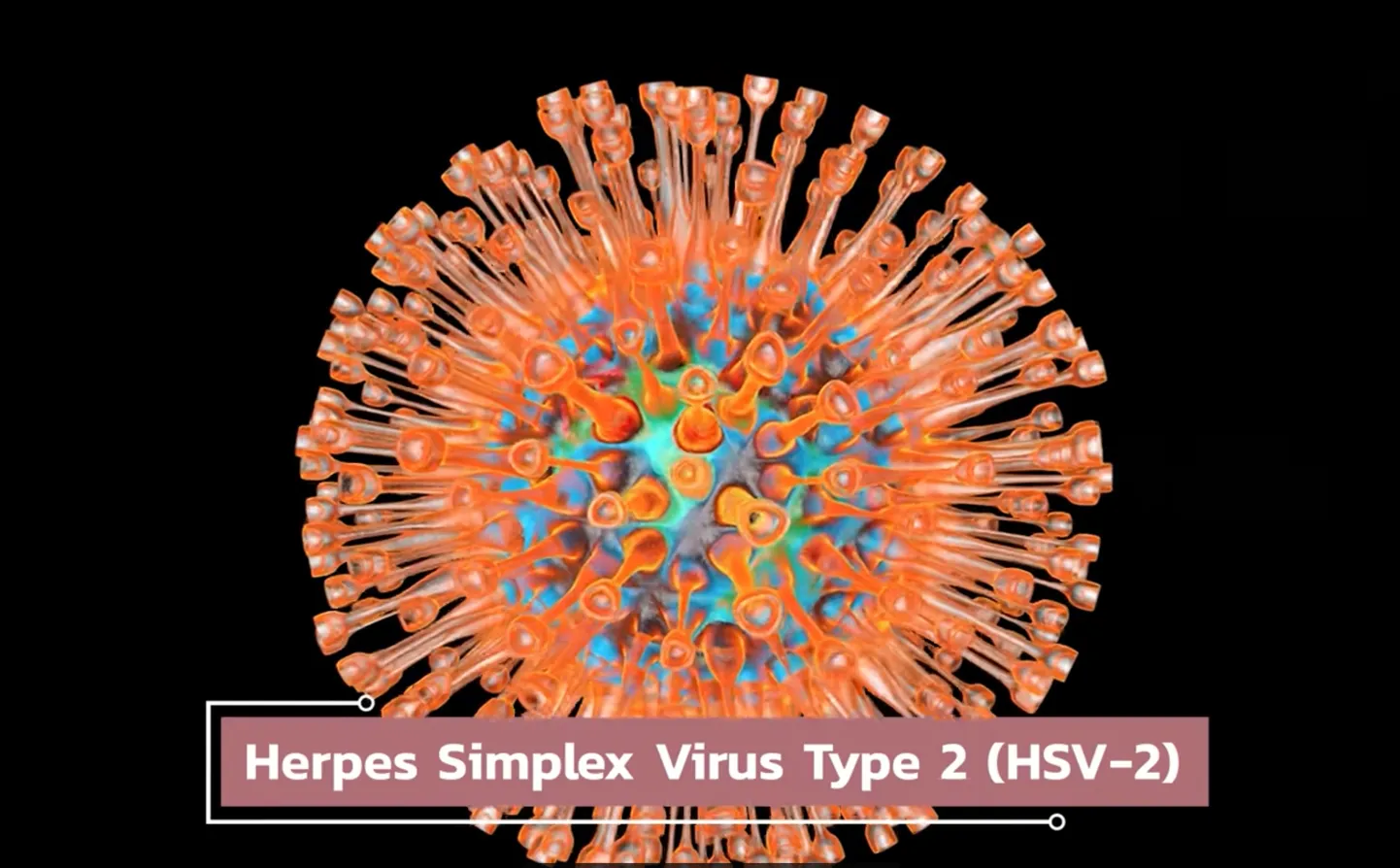 Herpes simplex viirus, tüüp 2.
