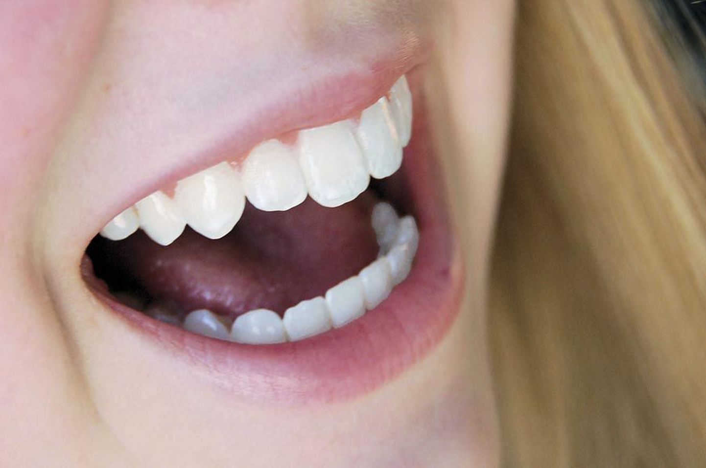 Paljudel inimestel on hammastel valged laigud.