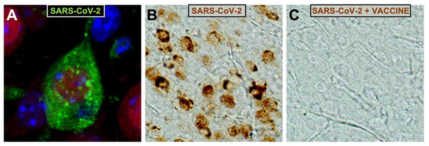 A) SARS-CoV-2 koroonaviirusega nakatunud ajukoore neuron (viirusosakesed on värvunud roheliseks). B) SARS-CoV-2-ga nakatunud ajukoore neuronid (pruuni värvi) ja C) nakkuse puudumine MVA-CoV2-S-ga vaktsineeritud hiirte samas ajupiirkonnas.