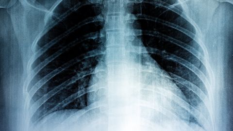 Scientists Discover Genetic Key to Cancer Susceptibility